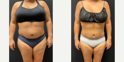 Woman treated with Semaglutide - Woman treated with Semaglutide