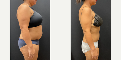Woman treated with Semaglutide - Woman treated with Semaglutide