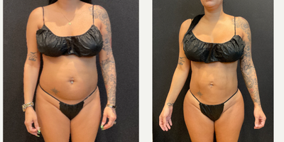 25-34 year old woman treated with Rib Removal, Abdominal Etching, Brazilian Butt Lift - Rib Repositioning by Dr. Franco