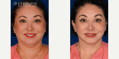 Woman treated with Chin Liposuction - Woman treated with SMAS Facelift, Neck Lift, and Chin Liposuction