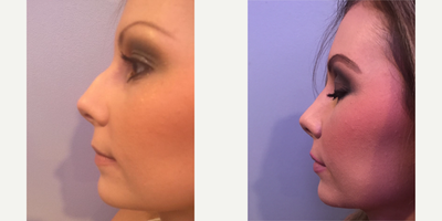 25-34 year old woman treated with Rhinoplasty - Patient treated with bilateral lower lid blepharoplasty with muscle sling.