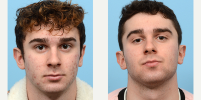18-24 year old man treated with AviClear - This 20-year-old patient underwent 3 treatments of AviClear to treat his acne. Five months after his third session, his skin looks super clear and he is thrilled with the results!