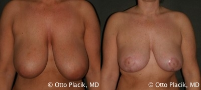 Breast Reduction - 
	Description: Bilateral breast reduction. Pre cup size: 34DD; Post cup size: 34D Patient Age: 32 Height: 5'5 Weight: 145
