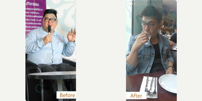 25-34 year old man treated with Gastric Balloon - Sleeve gastrectomy, also known as the gastric sleeve surgery, is a highly effective bariatric procedure that has gained popularity worldwide for individuals struggling with obesity and seeking a permanent weight loss solution. This procedure involves removing approximately 80% of the stomach, leaving a tube-shaped stomach about the size of a banana. The result is a significant reduction in the amount of food that can be consumed at one time, helping patients achieve and maintain substantial weight loss.