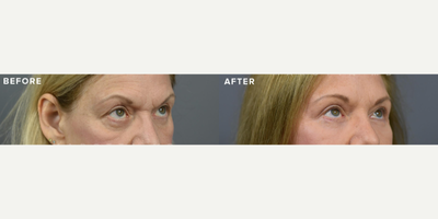 Woman treated with Brow Lift, Eyelid Surgery - Endoscopic Brow Lift + Blepharoplasty, our patient who underwent a rejuvenating transformation by Dr. Marotta!The patient had concerns such as upper eyelid skin excess, heaviness, lower eyelid skin excess, a hollow look, descent of the brow, and an overall tired appearance.An endoscopic brow lift addressed brow descent, providing a natural lift. Upper blepharoplasty targeted excess skin, creating a more youthful upper eyelid appearance. Laser treatment enhanced skin texture, while fat transfer added volume to achieve a rejuvenated, non-hollow look. A lower lid skin pinch ensured a smooth and refreshed lower eyelid contour. The after images speak volumes a refreshed, lifted brow, vibrant eyes, and a harmonious periorbital region. Our patient radiates confidence and a revitalized glow!