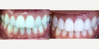 Woman treated with Dental Bonding, Teeth Whitening, Smile Makeover - Completing this smile makeover in under 72 hours (in time for a big event) was a fun project this week! No room for error on a time crunch! 4 conservative minimal preparation veneers, whitening & bonding and recontouring on the canines (to close what we call the incisal embrasures aka vampire teeth)