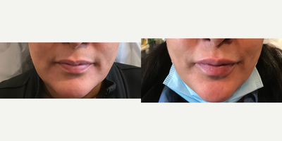 45-54 year old woman treated with Lip Fillers - Lip Enhancement with Juvederm Voluma 2cc