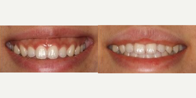 18-24 year old man treated with Lip Lowering - This patient's gummy smile was treated with upper lip lowering so the upper lip appears to be more full.