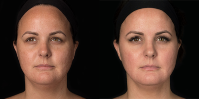 25-34 year old woman treated with Cosmelan - Cosmelan for a more even skin tone