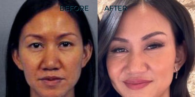 NYC Eyebrow Transplant - Eyebrow transplant performed in New York City.I over-plucked my eyebrows when I was young and it just never grew back. So I did microblading, I tattooed my eyebrows in the past, and that tattoo just really faded It was important to me to kind of look a little bit more natural with actual hair growth.