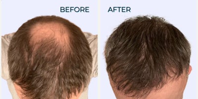 Scalp / Crown Hair Transplant - Crown transplant performed on 40-something year-old experiencing male pattern hair loss.