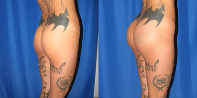 25-34 year old woman treated for Butt Augmentation with Implants - Buttock Augmentation with Implants, Oval 430 ccs