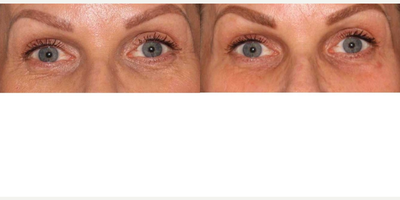 45-54 year old woman treated with CO2RE Intima - Patient treated with CO2RE Light