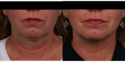 45-54 year old woman treated with Smart Lipo, PrecisionTx, Nonsurgical Neck Lift, Chin Liposuction, Fraxel Repair, Laser Resurfa - What can we offer patients requesting neck and jaw line tightening who dont want invasive surgery?  For my 54 year old patient, it was more about her busy work schedule and wanting to look refreshed in time for her sons wedding in this fall.  In my hands, could I give her even more results with a deep plane facelift.  The answer is yes.  Is she happy after her Precision Tx Laser Lift & Fraxel CO2 Repair treatment of her neck and jaw line?  She couldnt be happier which is why she wanted to share her results with you.  Her results can last up to 3 to 5 years.  The surgery was done under local with less than one week recovery time.