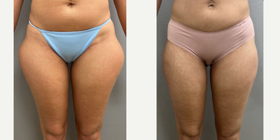 35-44 year old woman treated with Liposuction - 43 y/o, 6 months after outer thigh liposuction under sedation in our office O.R.