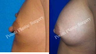 Nipple-Areola Repair - 	This patient was interested in getting breast implants as well as nipple reduction surgery.