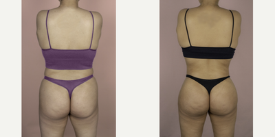 18-24 year old woman treated with Brazilian Butt Lift Revision - This patient had two prior BBL procedures by another surgeon and was unhappy with her results. She is shown here 6 months after surgery with me and is very happy with her improved volume, projection and natural result.