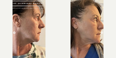 Woman treated with Cryoskin - Woman treated with Cryoskin