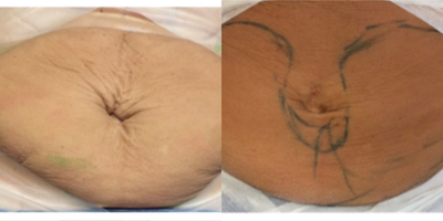 55-64 year old woman treated with UltraShape Power - after 2nd treatment