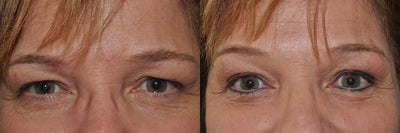 Permanent Eyeliner - 
	Permanent Eyeliner (Tattoo)
