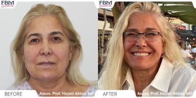 45-54 year old man treated with Deep Plane Facelift, Neck Lift, Eyelid Surgery, Facial Fat Transfer - 45-54 year old man treated with Deep Plane Facelift, Neck Lift, Eyelid Surgery, Facial Fat Transfer