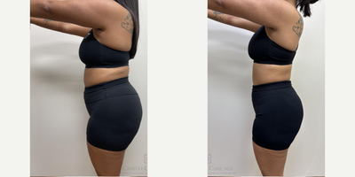Semaglutide for weight loss with Evolve Transform treatments for proactive skin tightening - This patient is seen here before and 27 weeks later.During her once weekly rounds of my #CashedOut Semaglutide Weight Loss program, which also includes a separate B-12 injection for energy, she received EvolveX Transform body sculpting treatments. These hands-free, pain-free treatments combine the benefits of radiofrequency (RF) energy and electrical muscle stimulation (EMS) to sculpt, tone, and tighten various areas of the body. It targets stubborn fat, enhances muscle definition, and improves skin elasticity, offering a comprehensive solution for body transformation without surgery or downtime. We especially love this treatment for Semaglutide patients since they can be safely performed throughout ones weight loss journey as a proactive measure against loose skin caused by rapid volume loss, a common concern known in pop-culture as Ozempic Butt.She is seen here before and 27 weeks after starting our Semaglutide weight loss program. At 51, her weight loss from 176 to 155 significantly reduced her BMI from 33.3 (obesity range) to a much healthier BMI of 29.4.