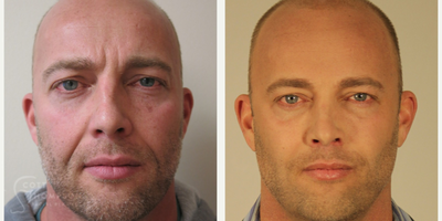 35-44 year old man treated with Juvederm - 41 year-old male with Non-surgical Facelift (Liquid Facelift) from Dr. Scott Thompson