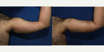 Fat Transfer to Biceps 1.0 - Fat Transfer to Biceps
