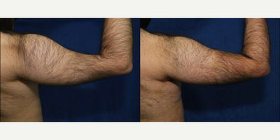 Fat Transfer to Biceps - Fat Transfer to Biceps