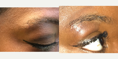 25-34 year old woman treated with Scar Removal - Excision done by Dr. Caughlin to remove this woman's car around her eyebrow.