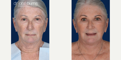 Woman treated with Facelift Revision - Woman treated with Facelift Revision and Neck Lift