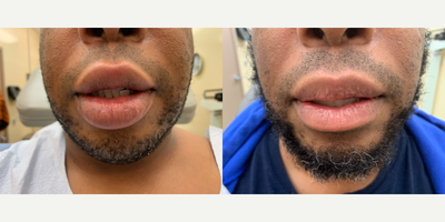 45-54 year old man treated with Lip Reduction - Before and 10 months after upper and lower lip reduction performed under local anesthesia.