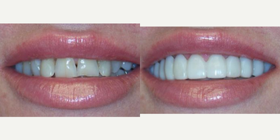 25-34 year old woman treated with Snap-On Smile - Before and after snap on smile