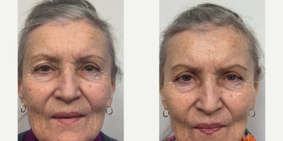 65-74 year old woman treated with Eyelid Surgery - 2 months after an upper eyelid blepharoplasty