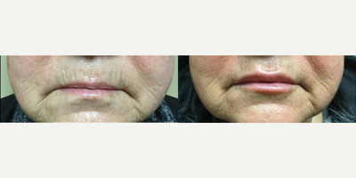 55-64 year old woman treated with Teosyal - Teosyal treatment for wrinkles around mouth and for lip enhancement.