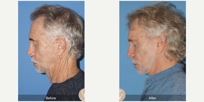 69 year old man treated with Lower Facelift, Neck Lift, Xeomin, PRP Injections - 69 year old man treated with Lower Face and Necklift, Fat Grafting with PRP to Malar and Forehead, Xeomin to Forehead