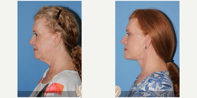 62 year old woman treated with Deep Plane Facelift, Neck Lift, Botox, MACS Facelift - 62 year old woman treated with Deep Plane Face and Neck Lift, Fat Grafting to Cheeks, Botox, MAC