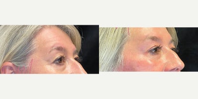 45-54 year old woman treated with Botox, Botox for Migraines - Treated by Aubrey Houchin, RN - Botox
