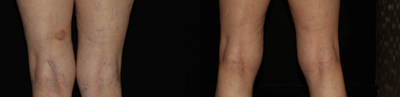 55-64 year old woman treated with Asclera - Results after two session of Asclera to spider veins on legs.