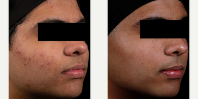 Man treated with AviClear - Man treated with AviClear