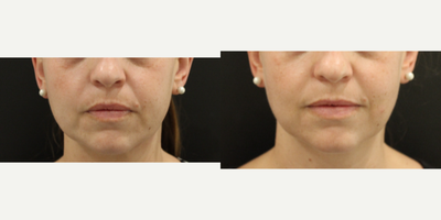 Clear & Brilliant - Please find attached before and after photo's as requested for Clear and BrilliantThis young woman presented seeking treatment for her melasma.
Her treatment plan is for 6 x Clear+ Brilliant treatments but home care. These photo's are before and after 3 Clear & Brilliant Original hand-piece. Homecare: Hydroquinone and Retinol (Fiori Skin Brightening Cream and Ultraceuticals Ultra A Perfecting Serum).
Skin clarity after 3 treatments is greatly improved.