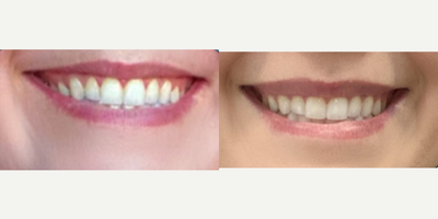 Lip flip results! - This client came in with concerns about her top lip turning under when she smiles. We decided to do a lip flip with Jeuveau and she had amazing results!