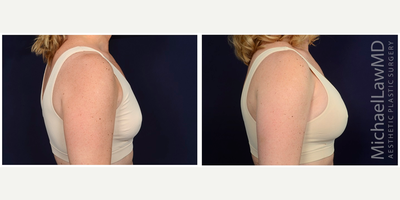 45-54 year old woman treated with Natrelle Breast Implants - Breast augmentation. Follow-up photos are taken 8 months after the procedure.