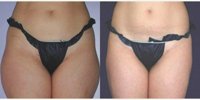 UltraShape - UltraShape