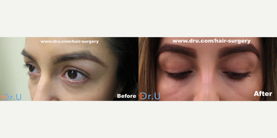 Eyelash Transplant - The truth is  you've tried the itchy and often heavy eyelash extensions, but ultimately not satisfied with results. After a while, eyelash extensions/fake eyelashes get expensive and your eyelashes are still short or scarce. However, there are permanent and natural options, eyelash transplant. Getting an eyelash transplant is entirely up to you, but if youre looking for long term and natural results, this may an option for you. VeeLashe, eyelash transplant uses body and/or pubic hair and proven to be a better suited option to augment your eyelashes. See, conventionally speaking, taking follicles from the scalp has been the method for providing eyelash donor grafts. But not with VeeLashe as it takes body or pubic hair. While some results may vary, with VeeLashe, eyelashes grow longer and fuller. You can read more about VeeLashe, the Dr. U Hair and Skin Clinic eyelash transplant at The VeeLashe Pubic Hair Eyelash Transplant Surgery by Dr.U in Los Angeles - Dr. Umar Hair and Skin Clinic Specialists: https://dru.com/veelashe-pubic-hair-eyelash-transplant-surgery-by-dr-u-los-angeles/