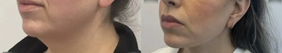 39 year old woman treated with Facelift, Neck Lift - 39 year old woman treated with Facelift, Neck Lift