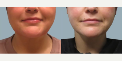 Woman treated with FaceTite - Woman treated with FaceTite
