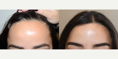 25-34 year old woman treated with Forehead Reduction - 26 years oldshown before and 4 months after hairline lowering surgery that created better facial harmony.