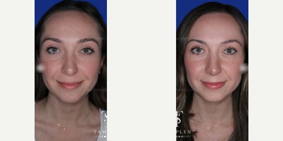 Woman treated with Revision Rhinoplasty - Woman treated with Revision Rhinoplasty