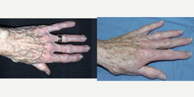 Patient  treated with Hand Rejuvenation - hand rejuvenation
